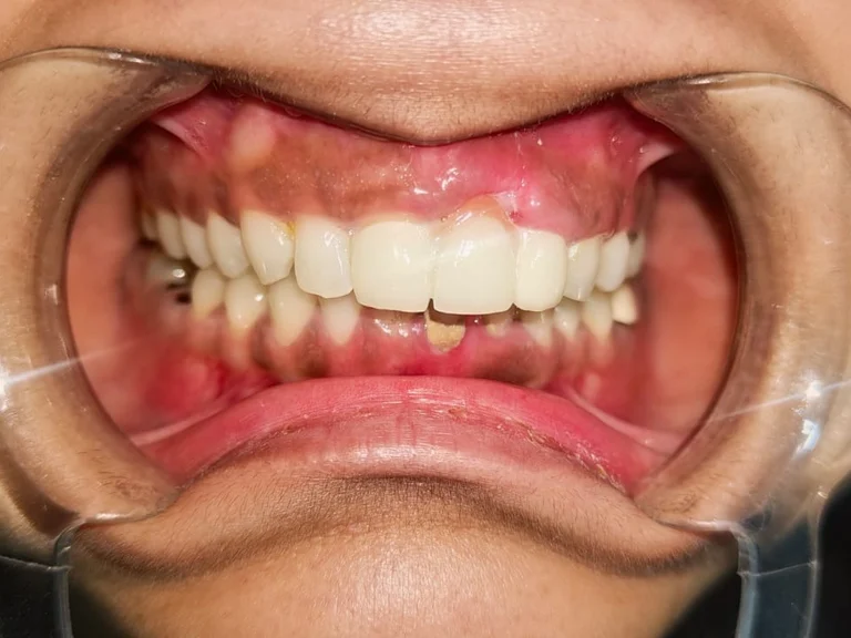 Upper Anterior Dental Bridge — after