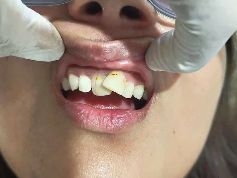 Upper Anterior Dental Bridge — before