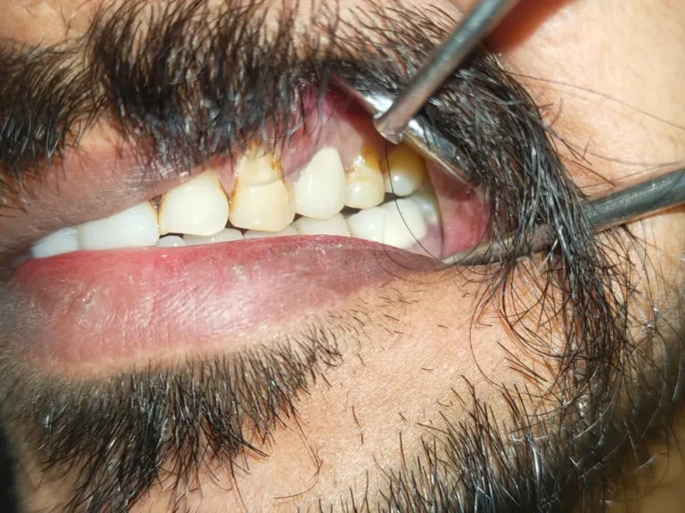 Anterior Dental Restoration — after