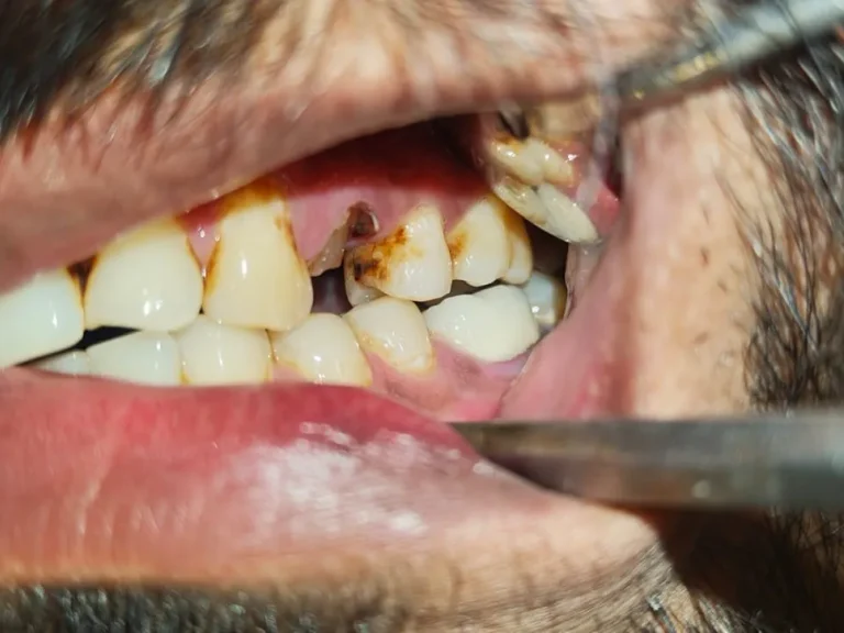 Anterior Dental Restoration — before
