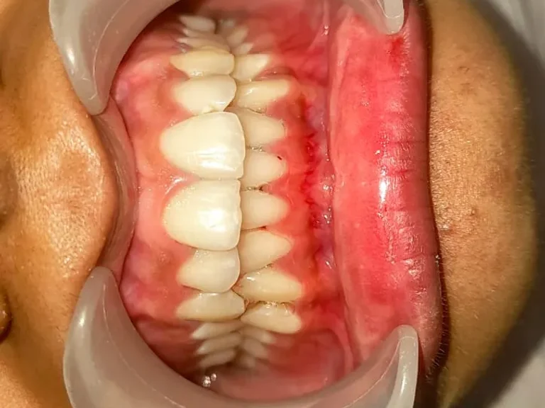 Deep Scaling and Gum Care — after