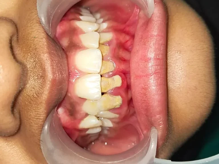 Deep Scaling and Gum Care — before