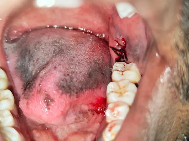 Wisdom Tooth Extraction — after