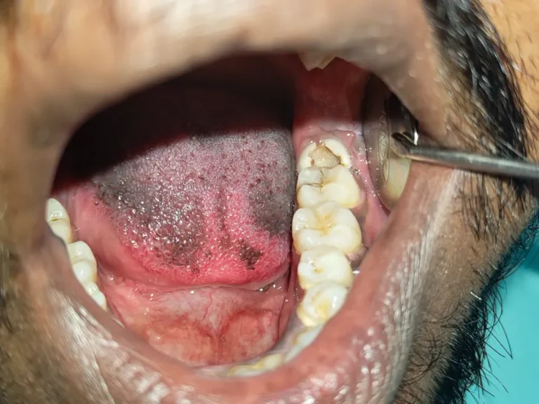 Wisdom Tooth Extraction — before