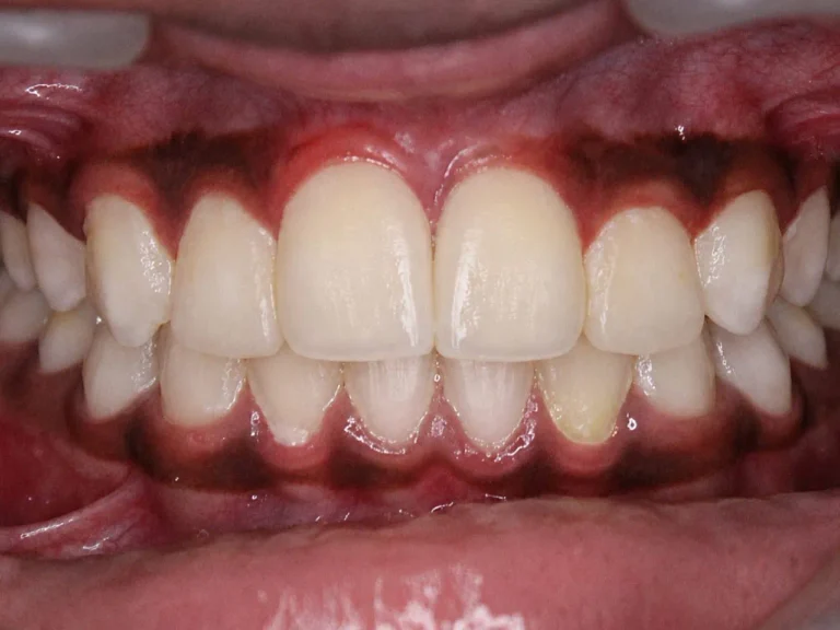Orthodontic Braces Treatment — after