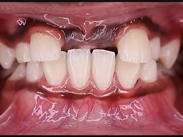 Orthodontic Braces Treatment — before